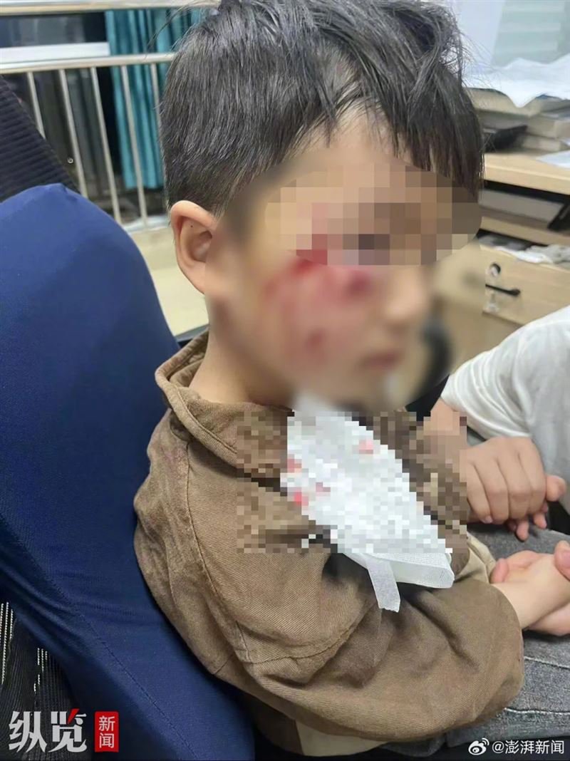 3岁男童小星到院时，被咬得全身伤痕累累，伤势集中在头脸部。 （图/翻摄微博）