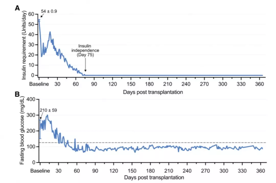移植后，患者胰岛素用量持续下降，直至无需再使用（上图）；空腹血糖水平长期稳定在正常值（下图）