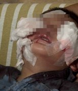 嘉县1岁男童遭狗扑倒猛咬!脸部严重撕裂伤送医